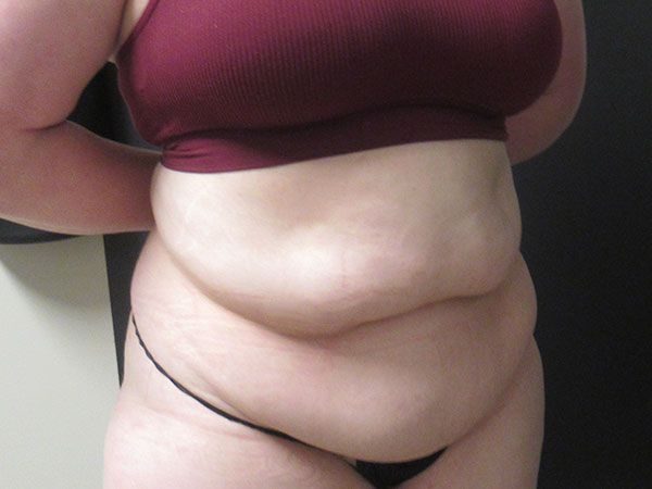 Abdominoplasty Before & After