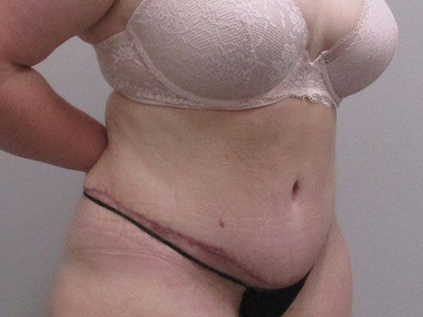 Abdominoplasty Before & After