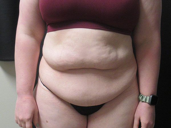 Abdominoplasty Before & After