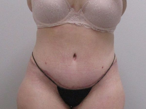 Abdominoplasty Before & After