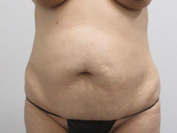 Abdominoplasty Before & After