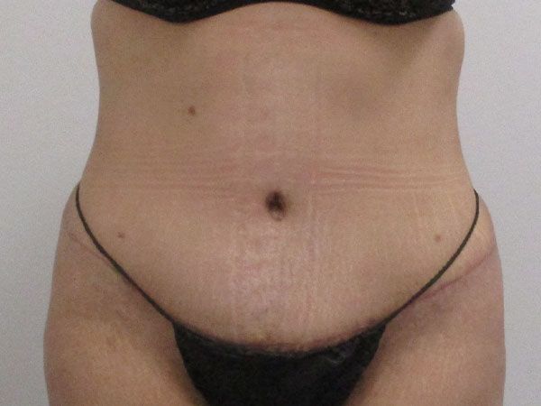 Abdominoplasty Before & After