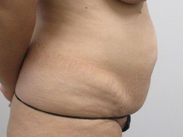 Abdominoplasty Before & After