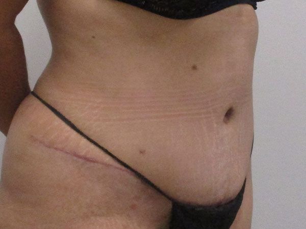 Abdominoplasty Before & After
