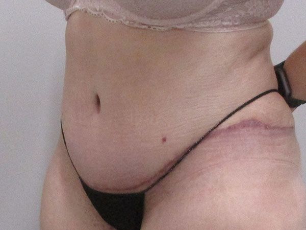 Abdominoplasty Before & After