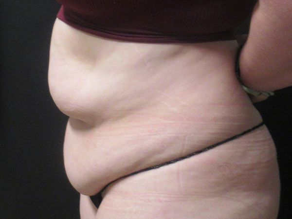 Abdominoplasty Before & After