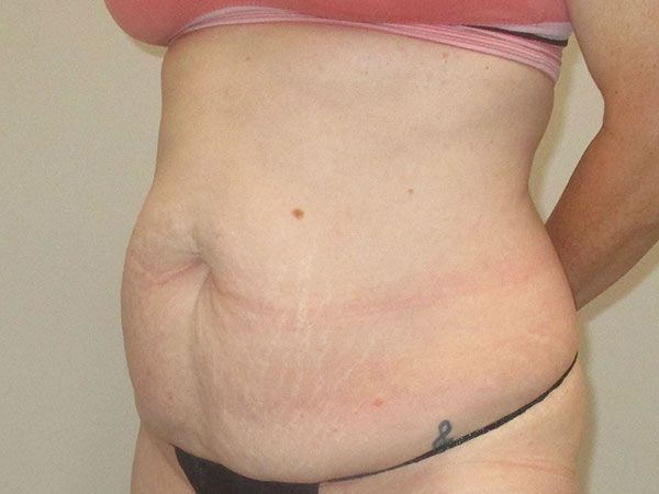 Abdominoplasty Before & After