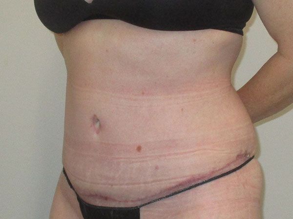 Abdominoplasty Before & After