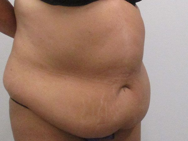 Abdominoplasty Before & After