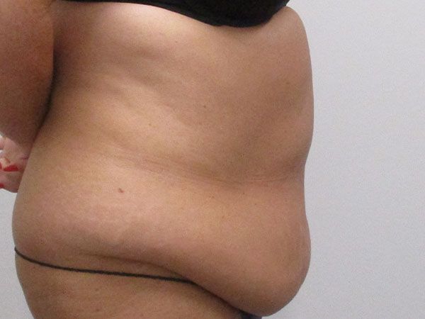 Abdominoplasty Before & After