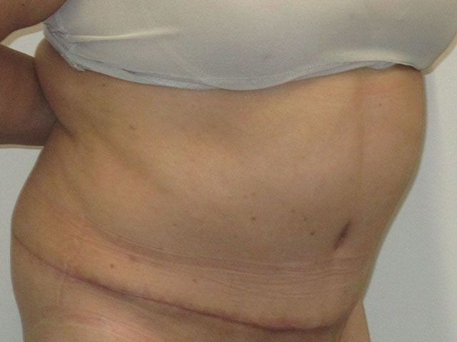 Abdominoplasty Before & After