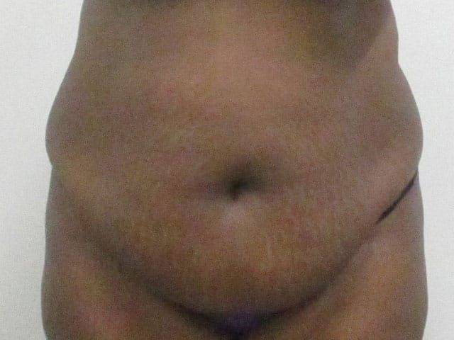 Abdominoplasty Before & After