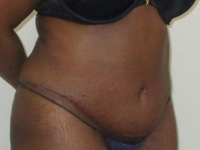 Abdominoplasty Before & After