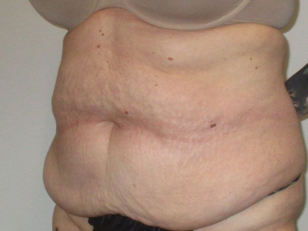 Abdominoplasty Before & After