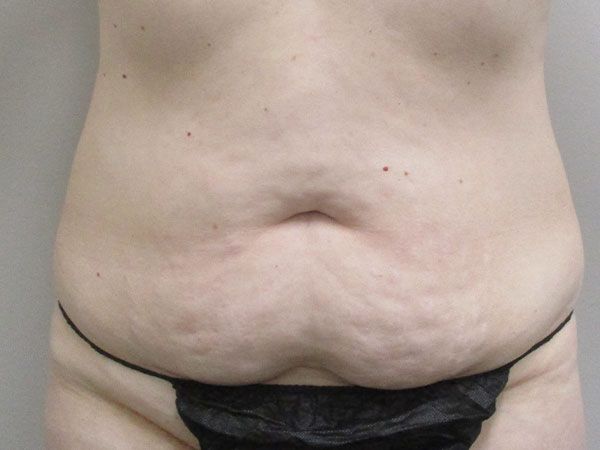 Abdominoplasty Before & After