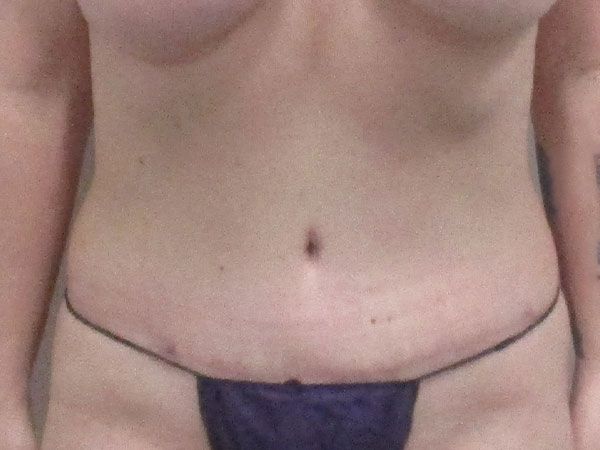 Abdominoplasty Before & After