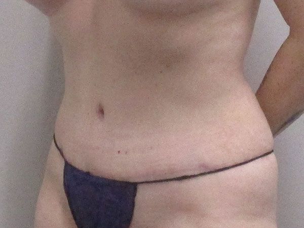 Abdominoplasty Before & After