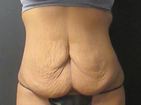 Abdominoplasty Before & After