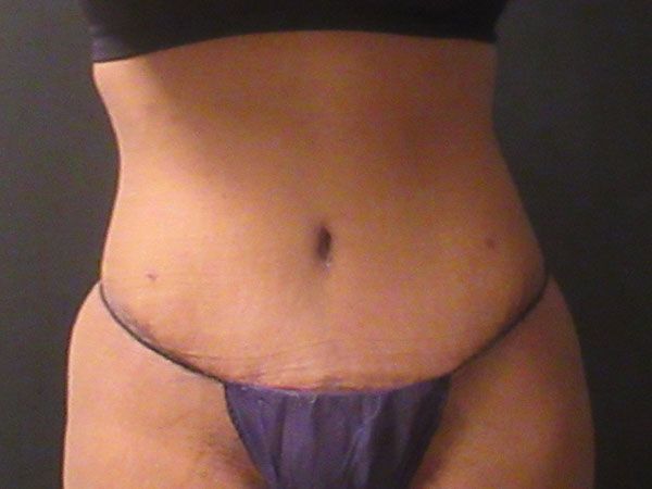 Abdominoplasty Before & After