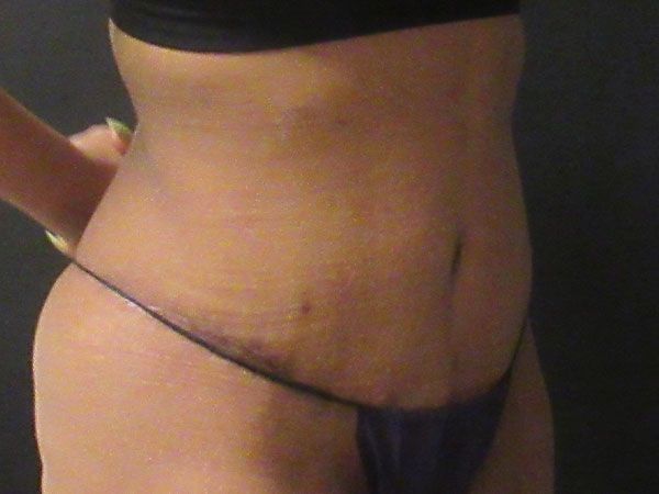 Abdominoplasty Before & After