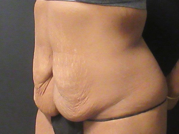 Abdominoplasty Before & After
