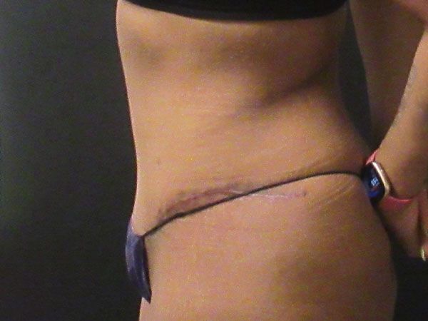 Abdominoplasty Before & After