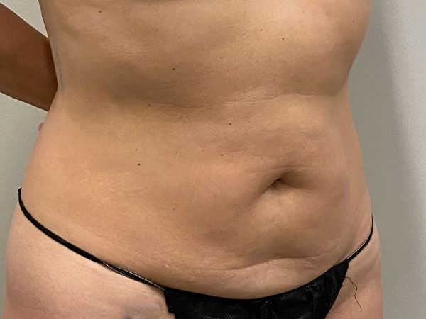 Abdominoplasty Before & After