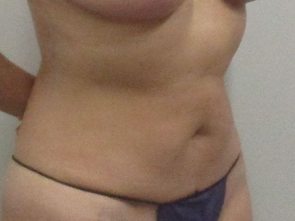 Abdominoplasty Before & After