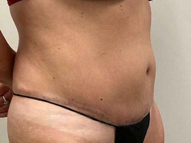 Abdominoplasty Before & After
