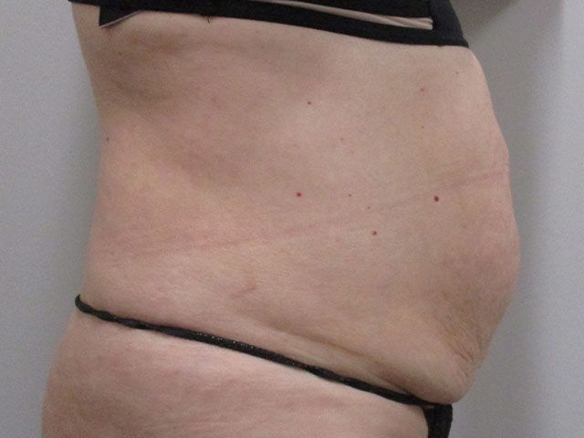 Abdominoplasty Before & After