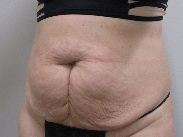 Abdominoplasty Before & After