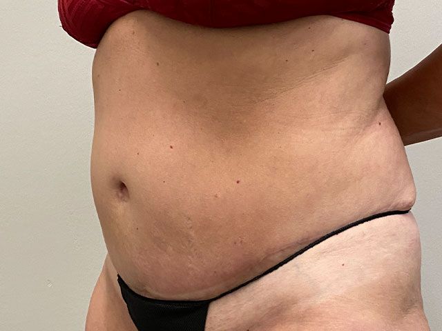 Abdominoplasty Before & After