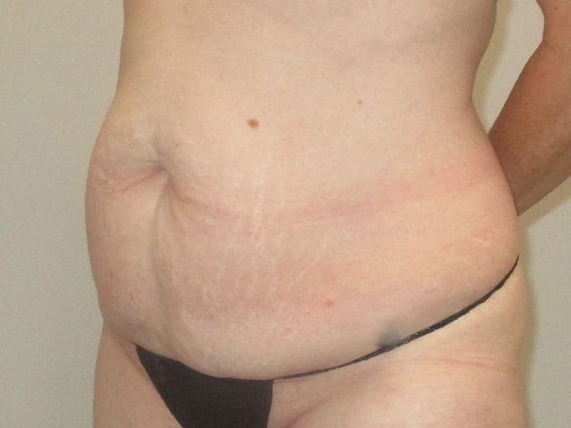 Abdominoplasty Before & After