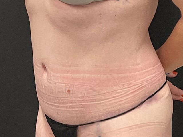 Abdominoplasty Before & After