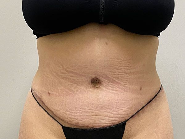 Abdominoplasty Before & After
