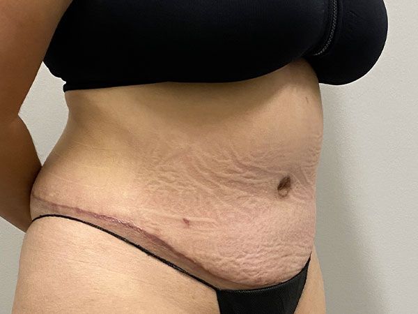 Abdominoplasty Before & After