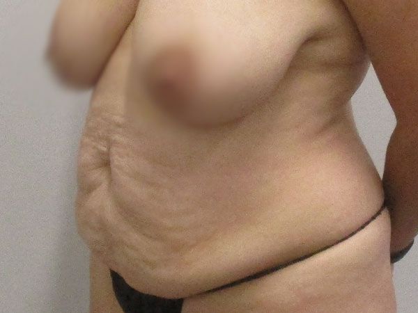 Abdominoplasty Before & After