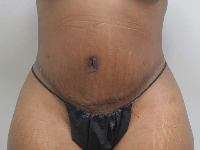 Abdominoplasty Before & After