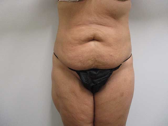 Abdominoplasty Before & After