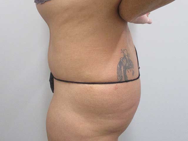 Abdominoplasty Before & After