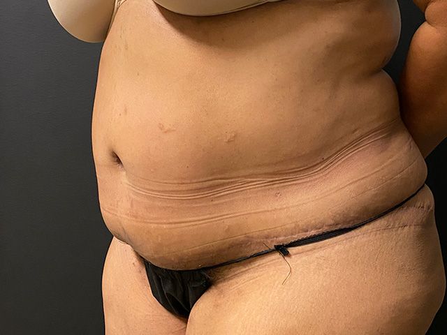Abdominoplasty Before & After