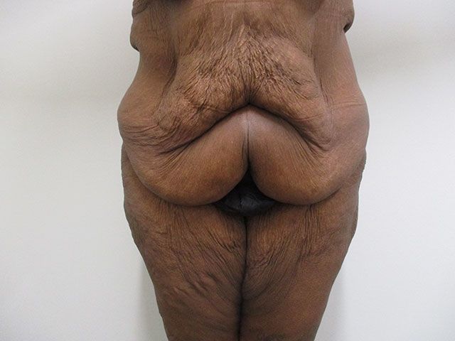 Abdominoplasty Before & After