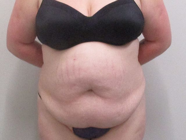 Abdominoplasty Before & After