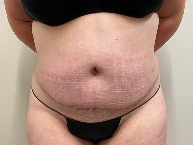 Abdominoplasty Before & After