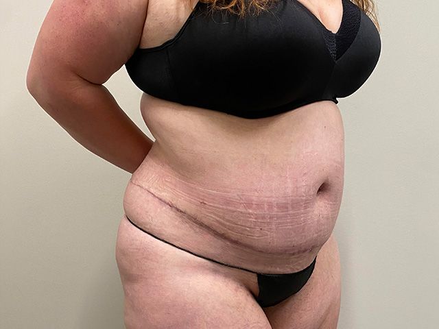 Abdominoplasty Before & After