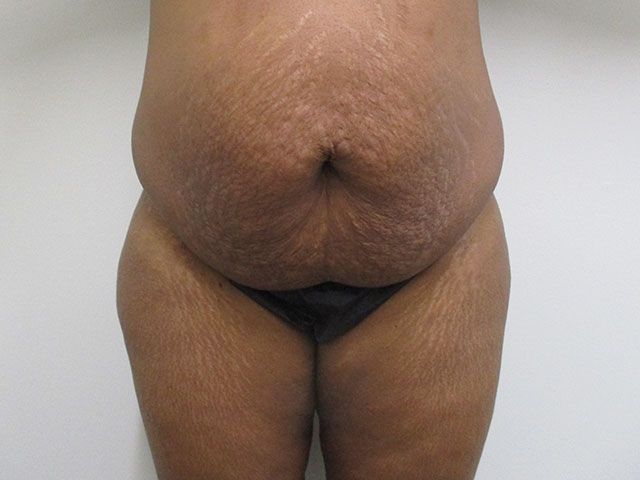 Abdominoplasty Before & After