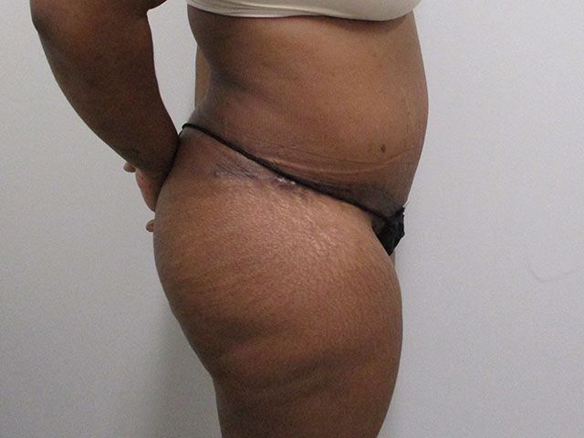 Abdominoplasty Before & After