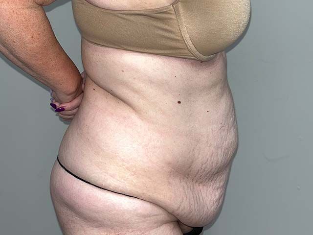 Abdominoplasty Before & After