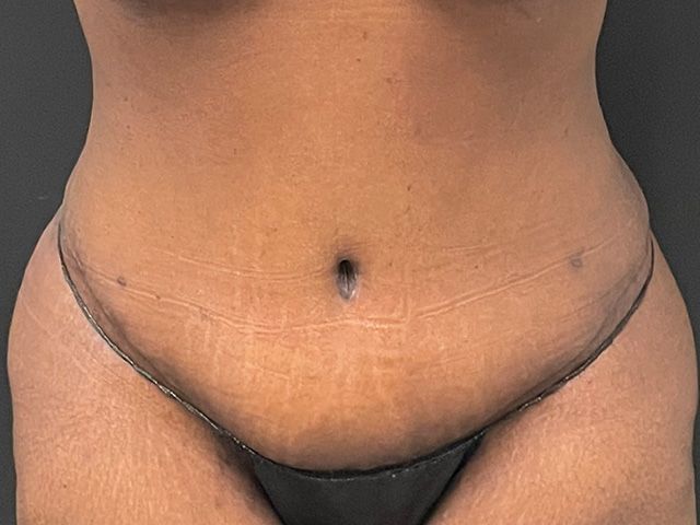 Abdominoplasty Before & After