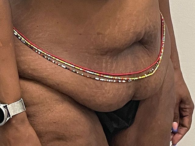 Abdominoplasty Before & After